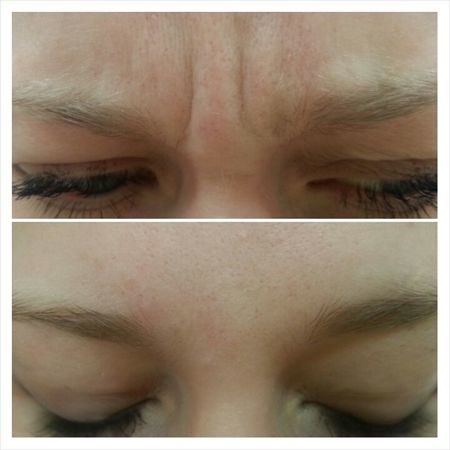 botox-mezhbrovnie-morshini